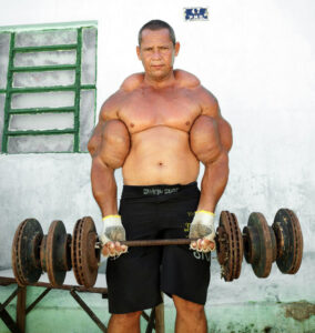 Omg Step Inside The Bizarre World Of Synthol Overloaded Bodybuilders