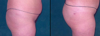 Brazilian Butt Fill Brazilian Butt Fill