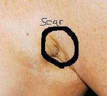 Lindsay Lohan breast implant scar